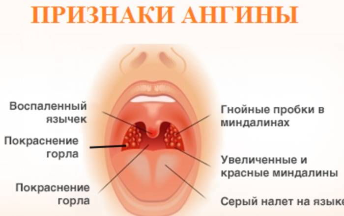 Зуд при ангине