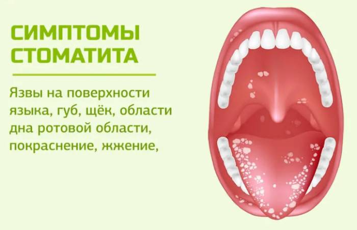 афтозный стоматит причины