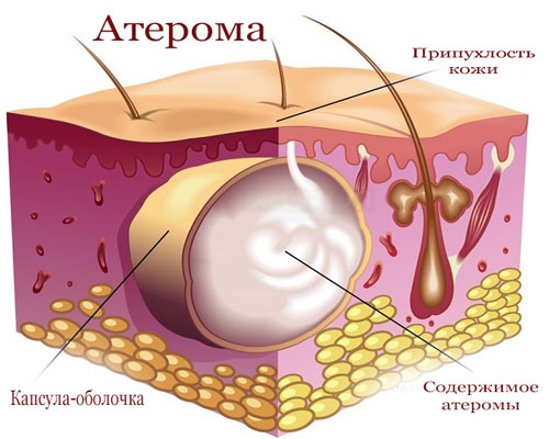 Как выглядит атерома на мошонке фото