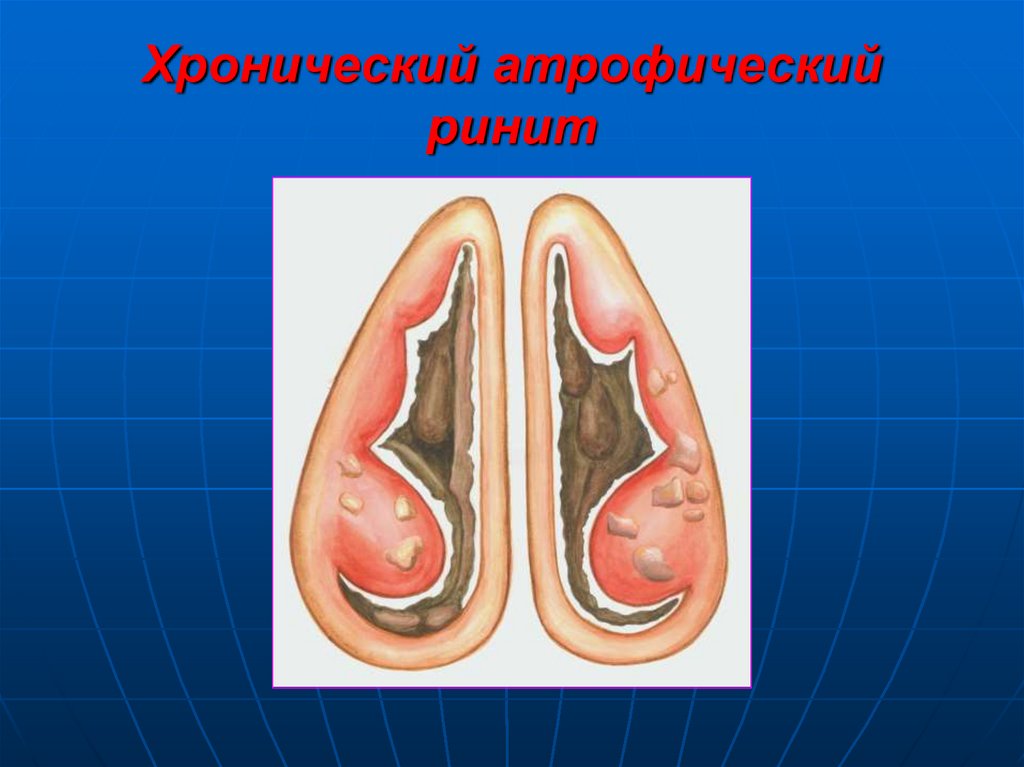 атрофический ринит