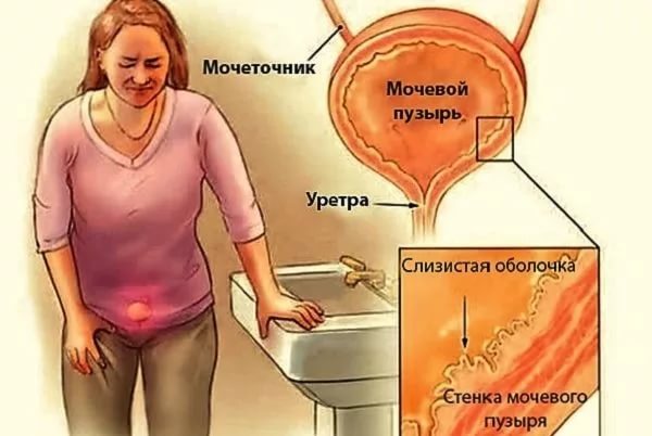 боли и жжения в уретре