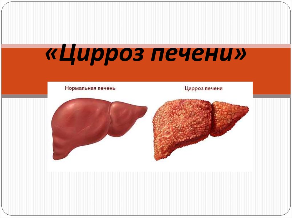 циррозе печени