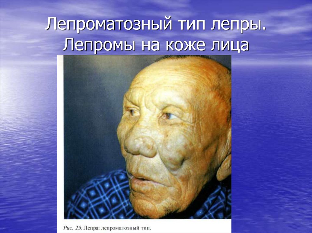 Лепроматозная лепра 