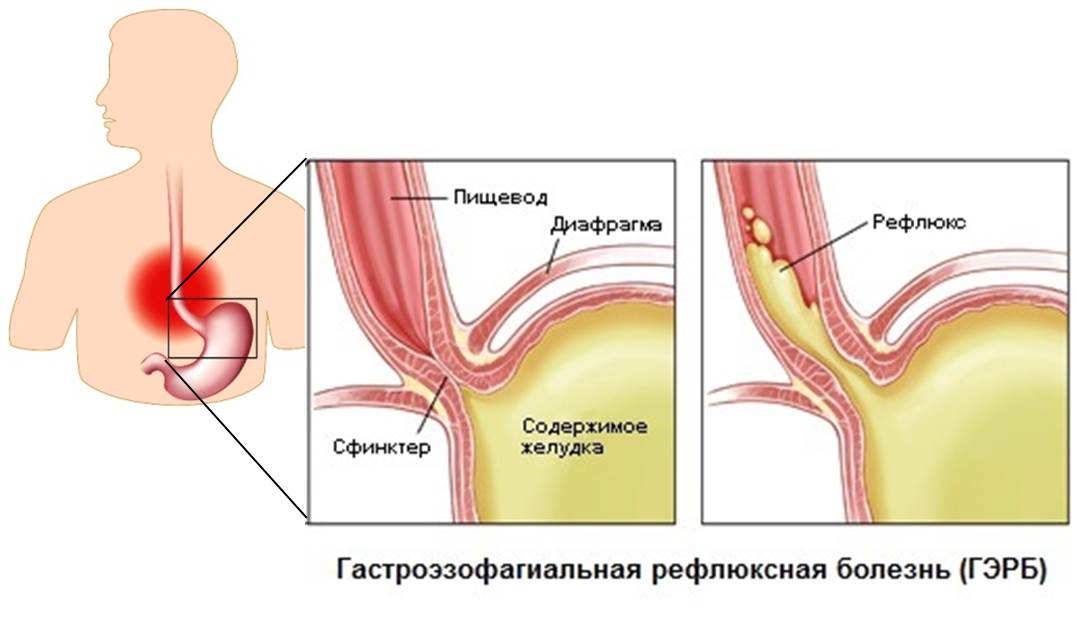 гастроэзофагеальная рефлюксная болезнь
