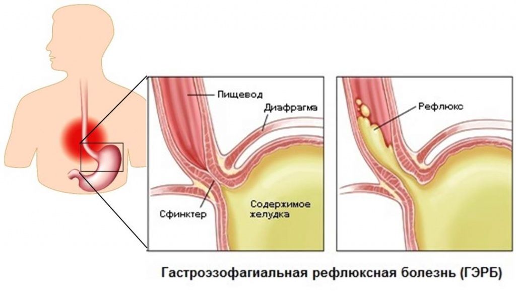 гастроэзофагеальной рефлюксной болезни