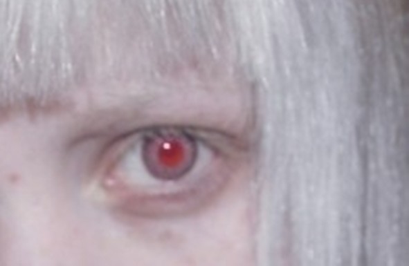 зуд