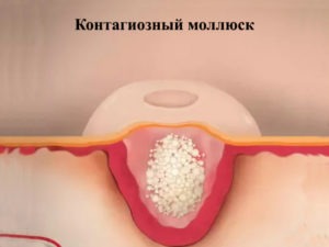 Контагиозный моллюск