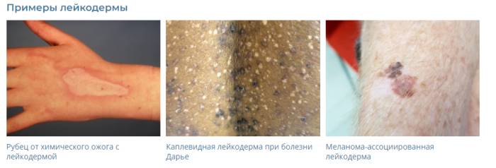 лейкодерму