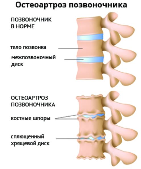 остеоартроза позвоночника.