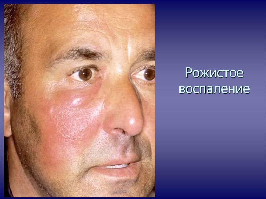 рожистого воспаления