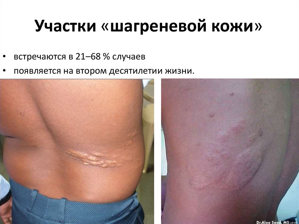 Шагрень – одно из заболеваний соединительной ткани