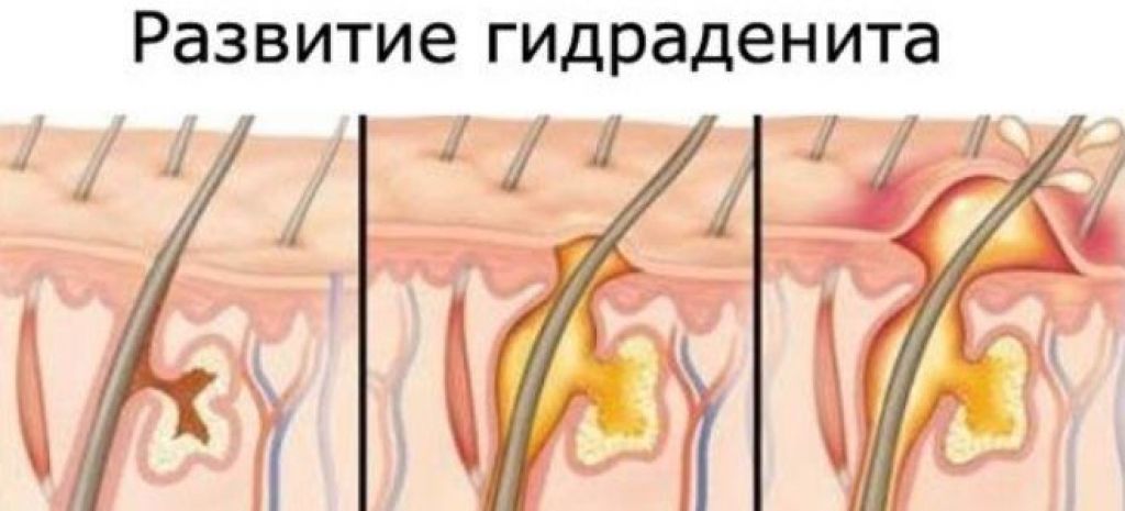 Симптомы гнойного гидраденита