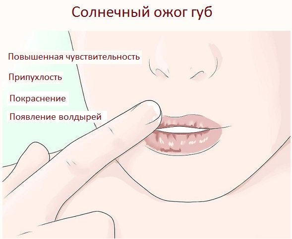 солнечный ожог губ