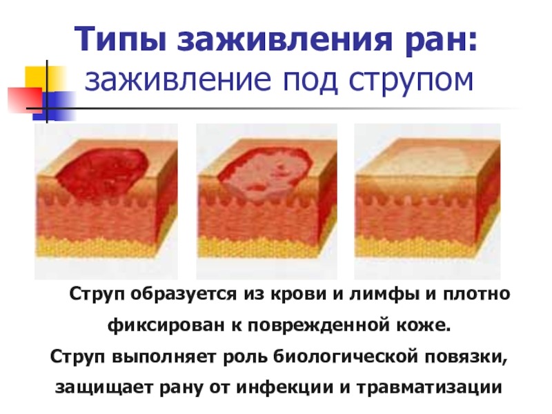 струп