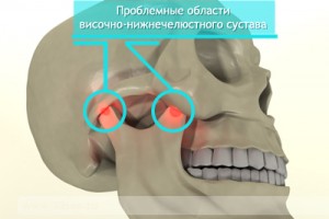 артроз челюсти