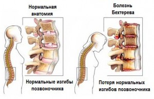 позвоночник при болезни бехтерева