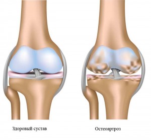 остеоартроза коленного сустава
