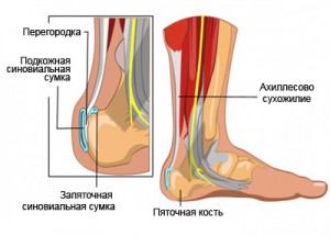 что такое ахиллобурсит