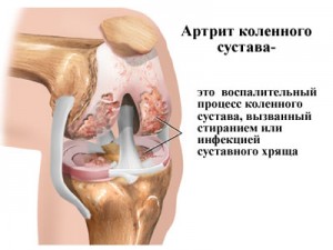 артрит коленного сустава