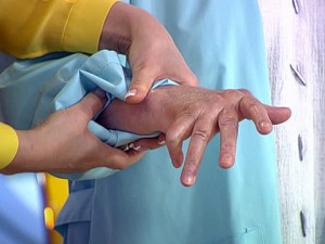 лечение артрита