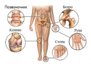 реактивный артрит