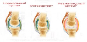 ревматоидный артрит