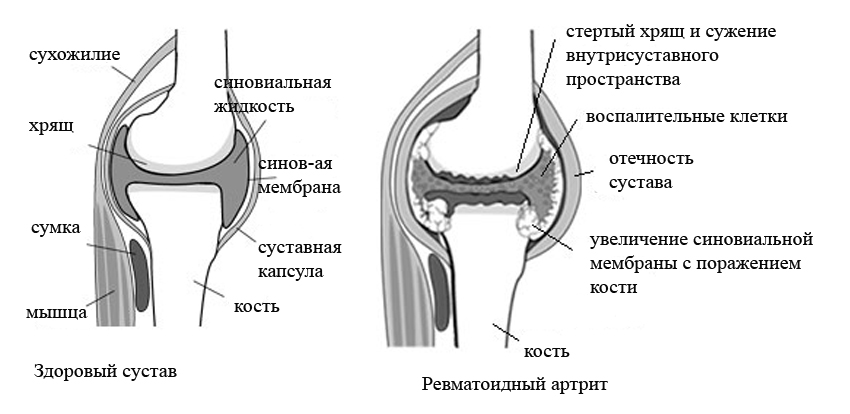 ревматоидный артрит