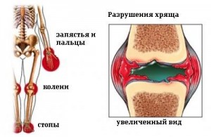 ювенильный ревматоидный артрит