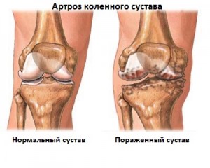 артроз коленного сустава