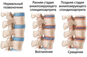 Что такое болезнь Бехтерева