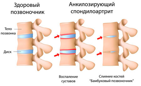 Болезнь Бехтерева