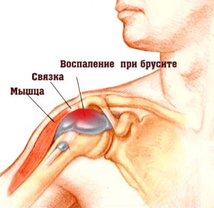 Основные виды бурсита