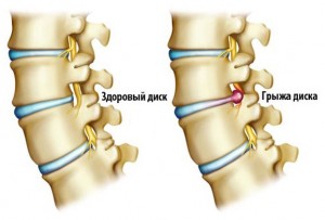 Грыжа позвоночника