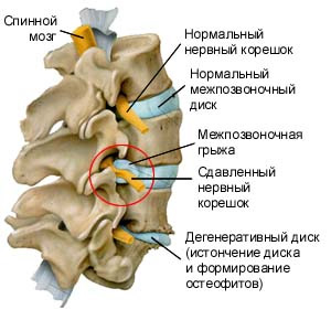 межпозвонковые грыжи