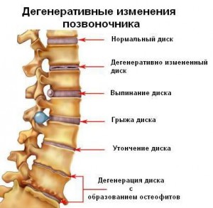 дегенерация позвоночника при спондилите