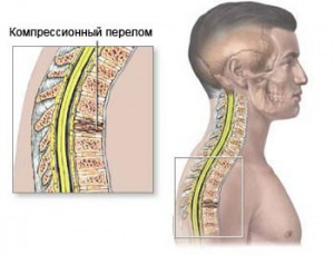 Компрессионный перелом позвоночника