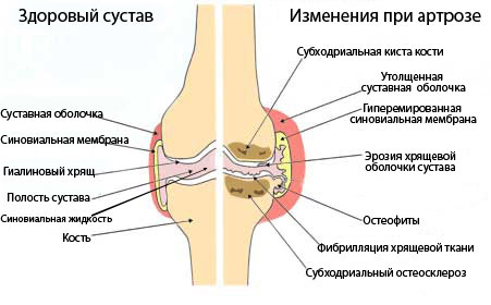 сустав при артрозе