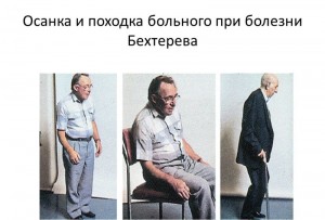 осанка при заболевании