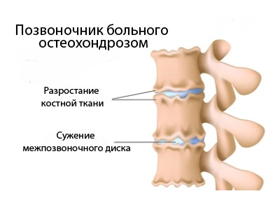 позвонки при остеохондрозе