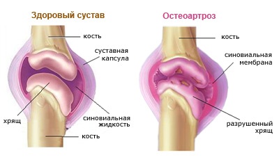 суставы при остеоартрозе