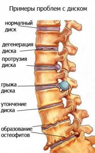 протрузия при остеохондрозе