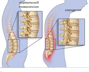 спондилит позвоночник