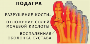 подагра