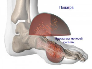подагра