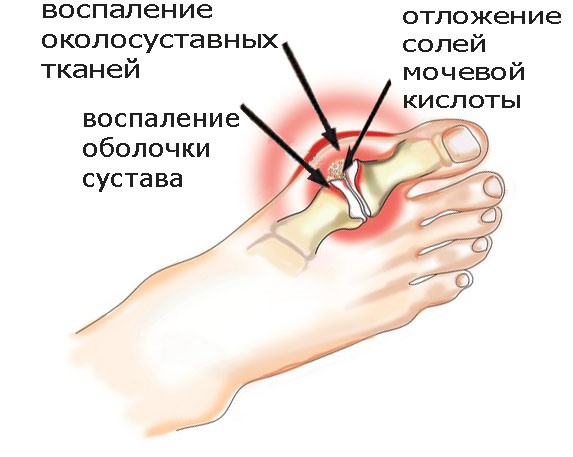 подагра