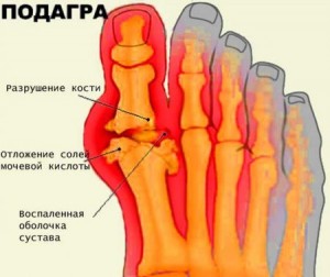 подагра на ногах