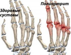 полиартрит пальцев рук