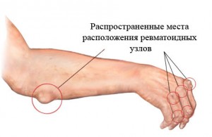 расположение узелков при артрите