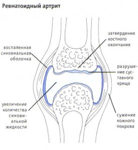 следствие ревматоидного артрита