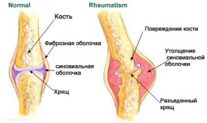 ревматизм